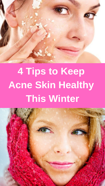 4 Tips to Keep Acne Skin Healthy This Winter