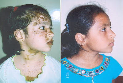 Jalgaon, Maharashtra- White Spot (Vitiligo) Specialist Doctor Kabra : सफ़ेद दाग विशेषज्ञ डॉक्टर काबरा, AnjNewsMedia