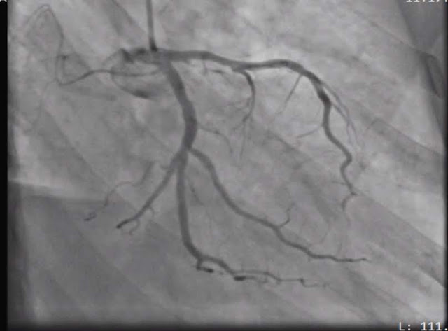 Figure 3: Coronary Angiography showing occluded diagonal.