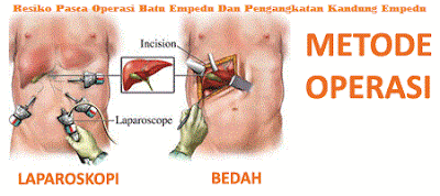 Obat Herbal Untuk Mengobati Penyakit Batu Empedu