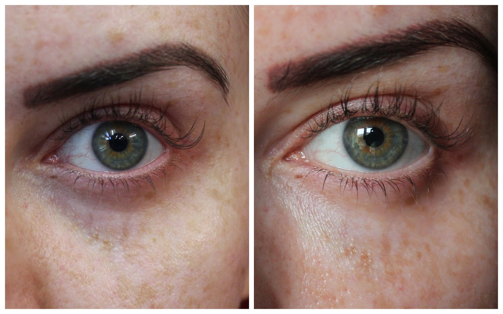 Tear Trough Filler Before And After At The Milo Clinic By Dr Milojevic (Non-surgical eye bag removal)