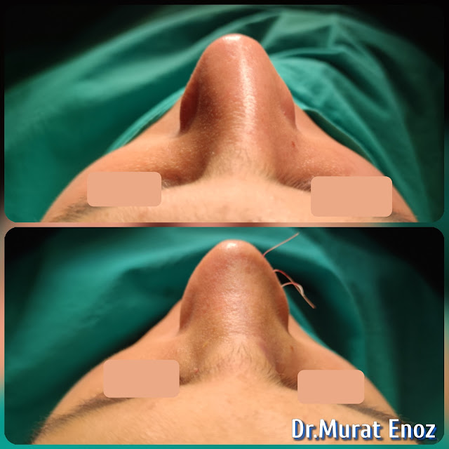 Tertiary Revision Nose Job Rib Cartilage Grafts Removal