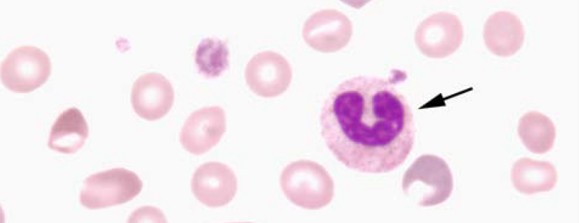 الكرية البيضاء المعتدلة بشكل نعل الفرسBand neutrophil