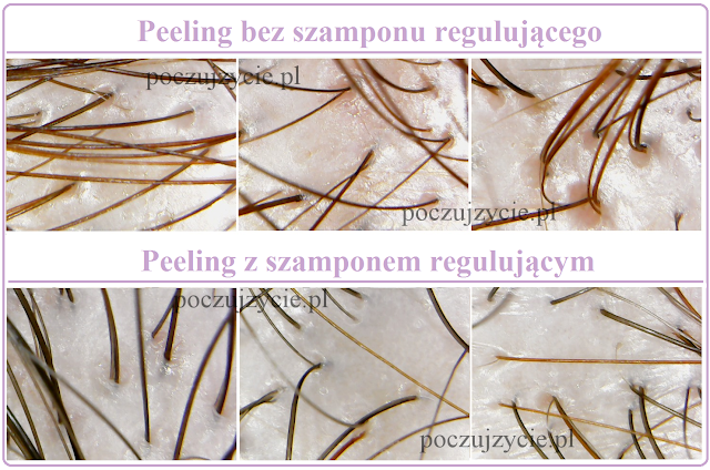 Peeling skóry głowy 1