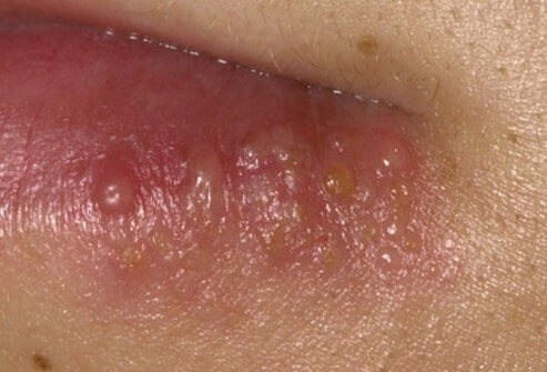 cara menghilangkan herpes