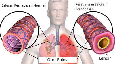 asma, peradangan saluran pernapasan, sesak napas