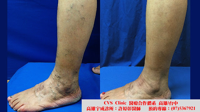 靜脈膠, 萬能膠, 黏膠閉合手術, 過敏反應, 類靜脈炎反應, 靜脈膠閉合手術, 微創靜脈勾除手術, 局部麻醉, 靜脈曲張, 蚯蚓狀, 網狀, 蜘蛛絲狀, 微創雷射手術, 硬化劑注射治療, 表皮雷射, 血栓靜脈炎, 色素沉澱, 腳痠脹, 腳疼痛, 血管超音波, varicose vein, EVLA, endovenous laser ablation, sclerotherapy, thrombophlebitis, reticular vein, spider vein, pigmentation, transcutaneous laser, Ambulatory phlebectomy, venaseal, vein glue, phlebitis, phlebitis-like abnormal reaction, PLAR, hypersensitivity 靜脈膠, 萬能膠, 黏膠閉合手術, 過敏反應, 類靜脈炎反應, 靜脈膠閉合手術, 微創靜脈勾除手術, 局部麻醉, 靜脈曲張, 蚯蚓狀, 網狀, 蜘蛛絲狀, 微創雷射手術, 硬化劑注射治療, 表皮雷射, 血栓靜脈炎, 色素沉澱, 腳痠脹, 腳疼痛, 血管超音波, varicose vein, EVLA, endovenous laser ablation, sclerotherapy, thrombophlebitis, reticular vein, spider vein, pigmentation, transcutaneous laser, Ambulatory phlebectomy, venaseal, vein glue, phlebitis, phlebitis-like abnormal reaction, PLAR, hypersensitivity