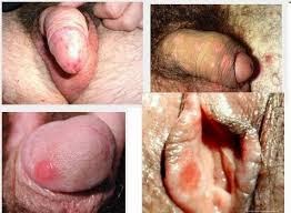 sipilis obat sipilis manjur