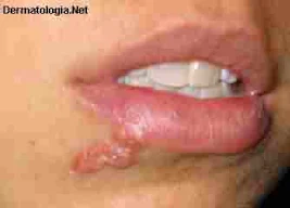 herpes labial