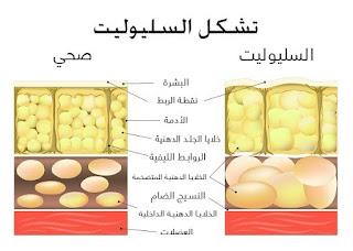 وصفات لعلاج السيولايت