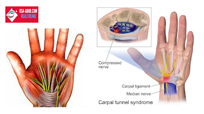 What Is Carpal Tunnel Syndrome (CTS)?