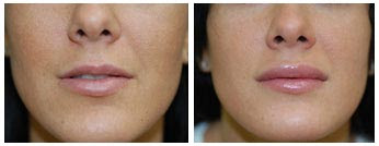 Lip Augmentation Before And After
