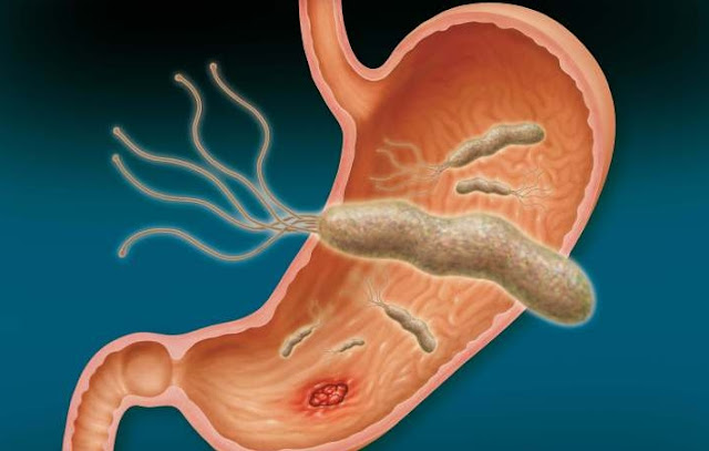 Helicobacter_pylori_the_cause_of_stomach_cancer