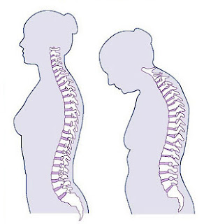 osteoporosis pictures