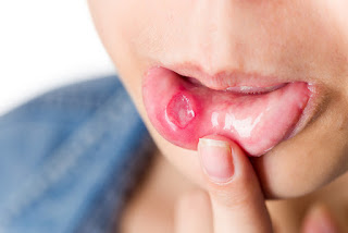 Mouth Ulcer