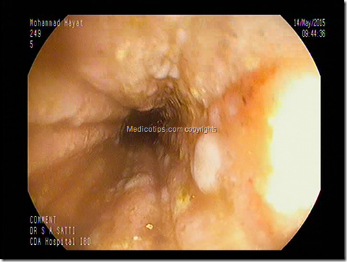 Esophagitis endoscopic view