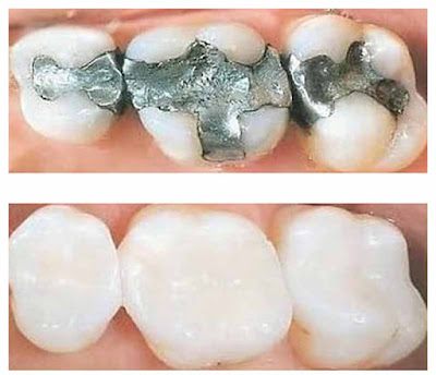 Những trường hợp cần trám răng là gì?