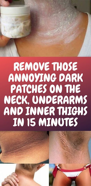 Remove Those Annoying Dark Patches On The Neck, Underarms And Inner Thighs In 15 Minutes