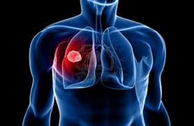 Mesothelioma Lawyer Firm