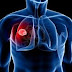 Mesothelioma Lawyer Firm