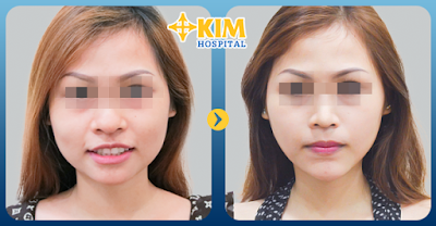 Hình ảnh trước và sau khi làm mũi nhỏ lại bằng phẫu thuật thẩm mỹ tại KIM Hospital