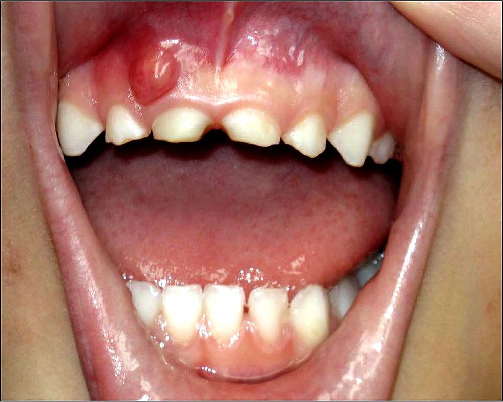 Infección Odontogenica