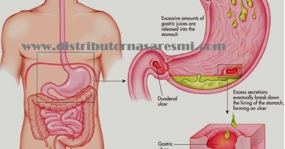 Gastritis Merupakan Panyakit Karena Gangguan ? - Sendawa ...