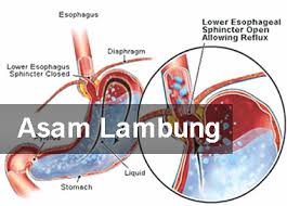 Penyebab Penyakit Asam Lambung Tinggi Atau Naik