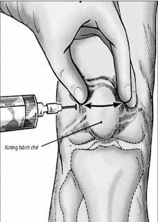 thoái hóa khớp