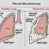 The Facts about Pleural Mesothelioma