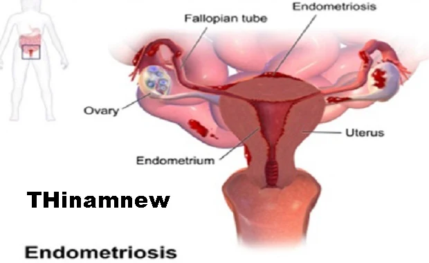 எண்டோமெற்றியோசிஸ் (ENDOMETRIOSIS) அறிகுறிகள் 