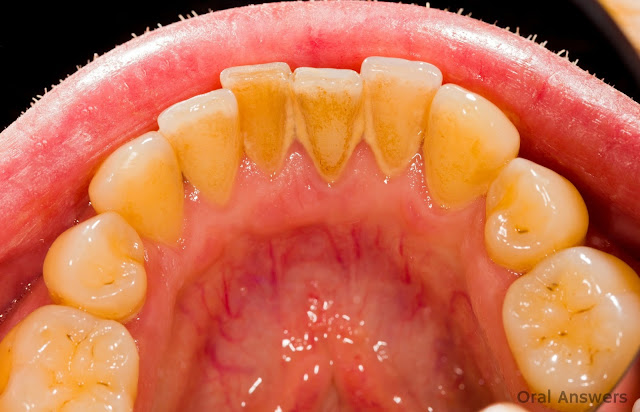 Remove The Tartar On Teeth And Gums By Using This One Simple Ingredient!