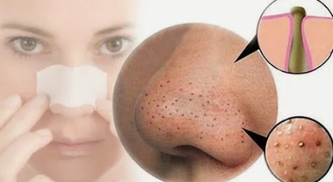 Home Remedies for Permanent Blackheads Removal