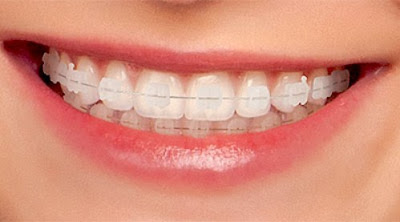 Niềng răng thẩm mỹ có đau không?