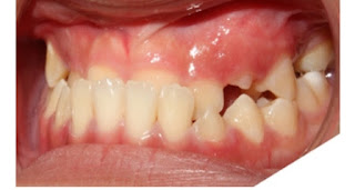 Nhận dạng khớp cắn ngược qua tương quan 2 hàm răng