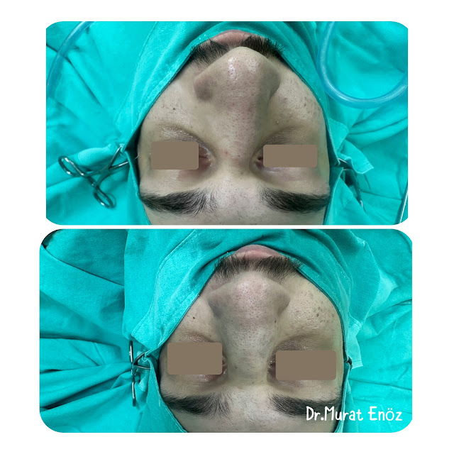 Closed technique, nasal fracture, reduction, general anesthesia, closed reduction, nasal bones, nasal trauma, nasal realignment, closed reduction procedure, post-operative care, recovery, anesthesia administration, nasal manipulation, alignment confirmation