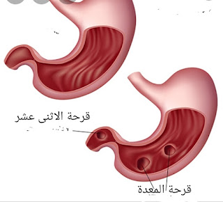 متى تلتئم قرحة المعدة