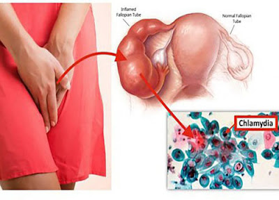 Bệnh chlamydia ở nữ giới