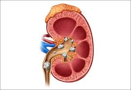 Best home remedies for kidney stones