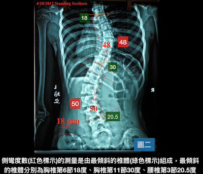 脊椎側彎, 脊椎側彎矯正, 脊椎側彎治療, 脊椎側彎矯正運動, 脊椎側彎 瑜珈, 脊椎側彎復健