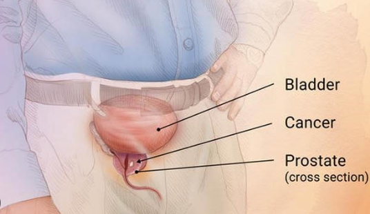 kanker prostat bisa terjadi pada