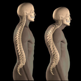 gambar penyakit tulang osteoporosis