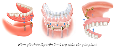 Các kỹ thuật cấy ghép implant khi bị mất nhiều răng