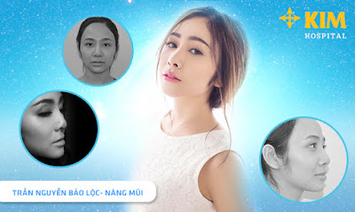 Nâng mũi S line sẽ cho bạn kết quả đẹp tự nhiên