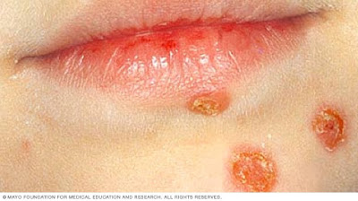 impetigo penyakit kulit menyiksa balita