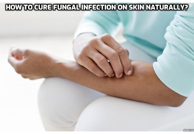 Skin Fungus Treatment – Having skin fungus is not life-threatening, but it is still very hard to manage. Treat it before it gets out of hand with the following easy home remedies and it will be gone before you know it. 