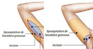 Liposuccion bras photo avant et après