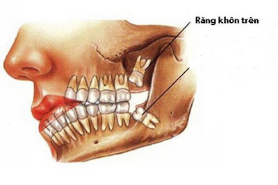 Làm gì khi mọc răng khôn