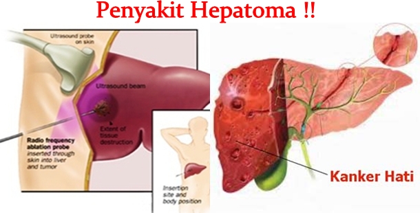 Obat Tradisional Hepatoma