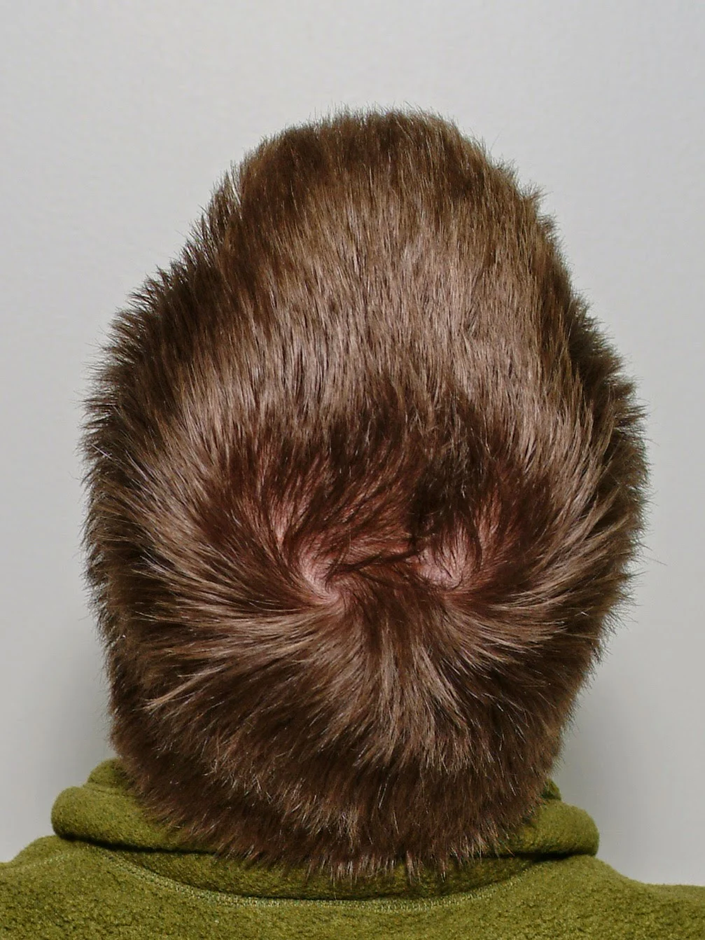 sore scalp hair loss